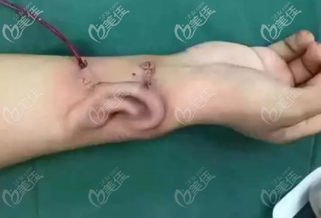 自體肋軟骨耳再造技術(shù)