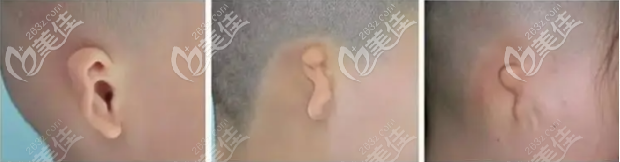 耳畸形程度等級(jí)