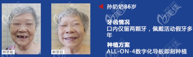 在做過全口即刻種植牙的叔叔阿姨們都怎么樣了？