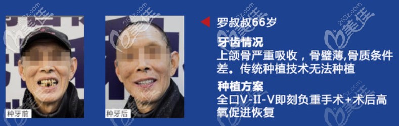 羅叔叔的即刻種植牙前后對比圖