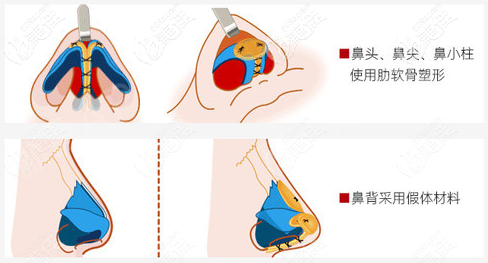 朱家旭肋骨鼻的技術(shù)特點(diǎn)