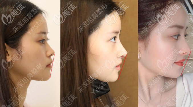 重慶藝星朱家旭半肋軟骨隆鼻的案例效果圖