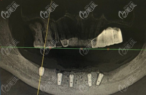 都說(shuō)牙槽骨薄種牙有風(fēng)險(xiǎn),那他為啥選擇做了半口即刻種植？