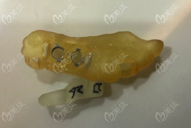 雅悅齒科種牙時使用的種植導(dǎo)板