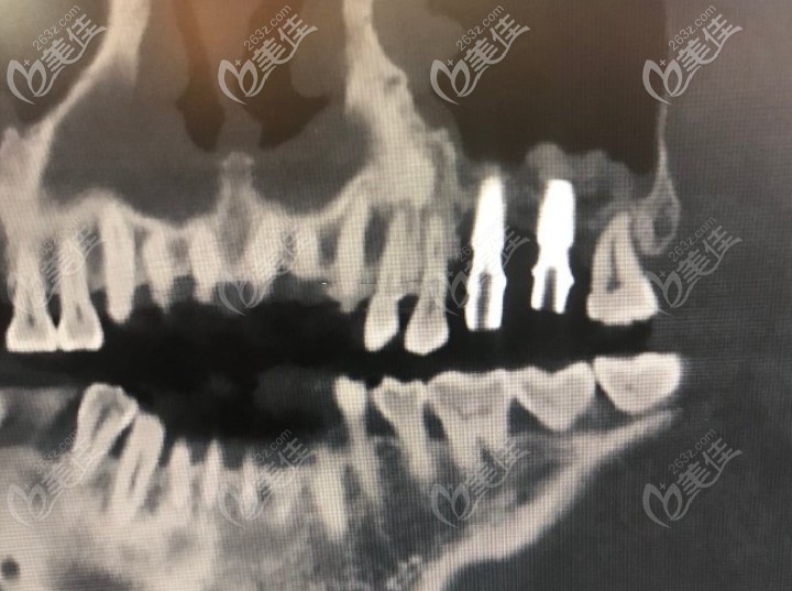 做了兩顆牙齒后拍的CT