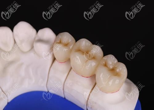 水晶鋯全瓷牙比較稀缺