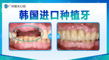 廣州曙光口腔醫(yī)院種植牙怎么樣 廣州曙光口腔醫(yī)院種植牙怎么樣
