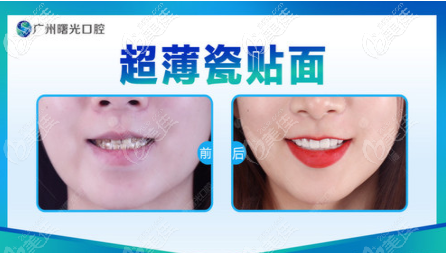 廣州曙光口腔醫(yī)院牙貼面<span style=