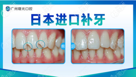廣州曙光醫(yī)院口腔科補(bǔ)牙<span style=