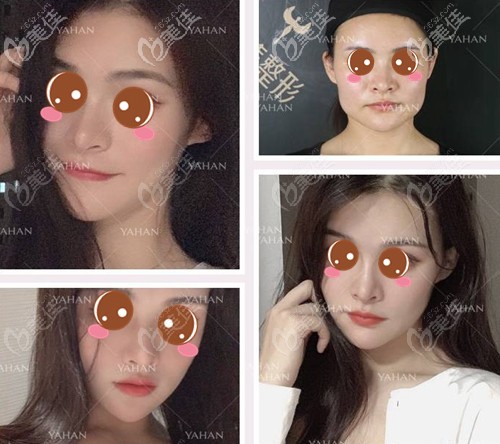 趙貴慶顴骨內(nèi)推+長(zhǎng)曲線下頜角案例