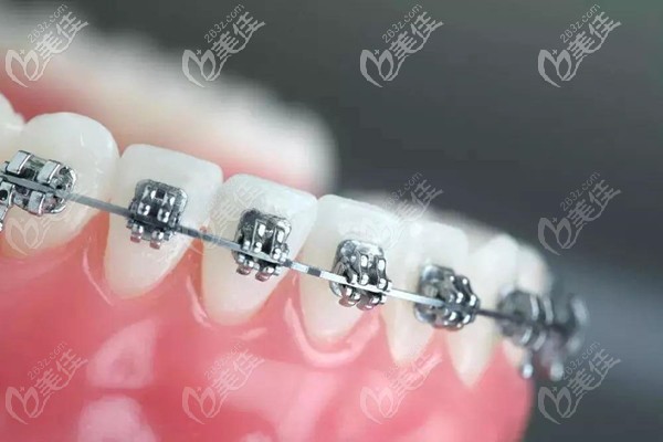 金屬自鎖矯正器 金屬自鎖矯正器