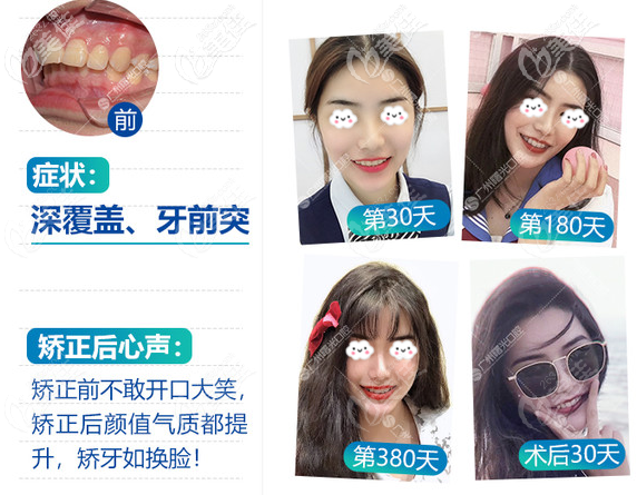 廣州曙光口腔醫(yī)院牙齒矯正怎么樣 廣州曙光口腔醫(yī)院牙齒矯正怎么樣