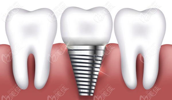 種植牙技術(shù) 種植牙技術(shù)