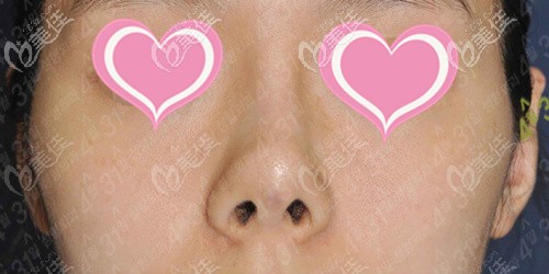 隆鼻后鼻頭攣縮