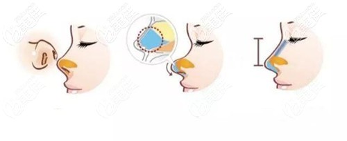 鼻頭攣縮修復(fù)手術(shù)過程