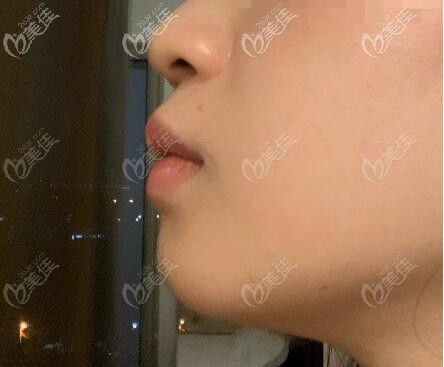 做下巴截骨前移手術(shù)前照片 做下巴截骨前移手術(shù)前照片