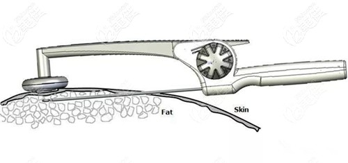 射頻溶脂的過程原理 射頻溶脂的過程原理