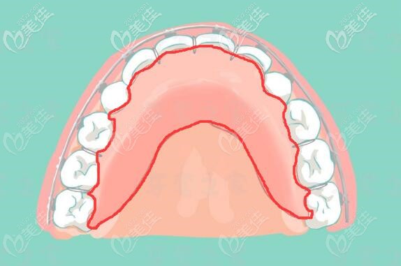 傳統(tǒng)的平導(dǎo)器