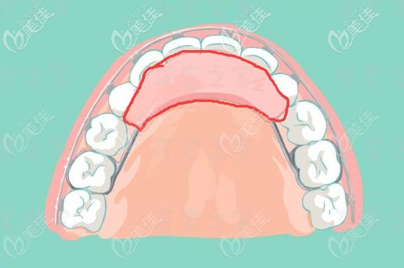 改良后平導(dǎo)器