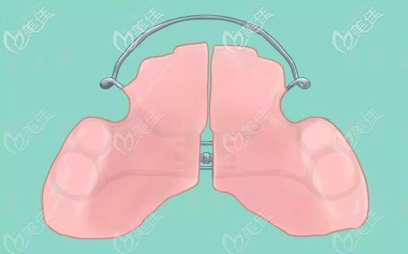 加入擴(kuò)弓的平導(dǎo)