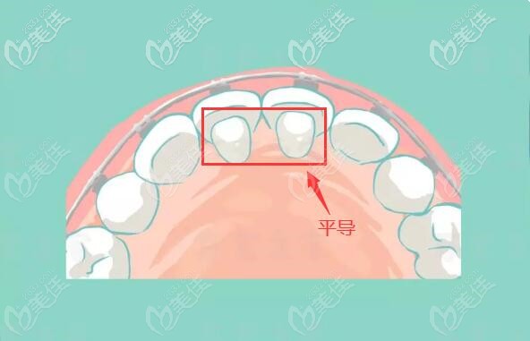 迷你型平導(dǎo)矯正器