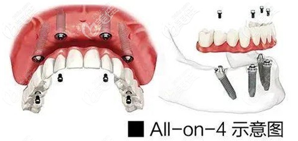 ALL- on-4種植牙技術