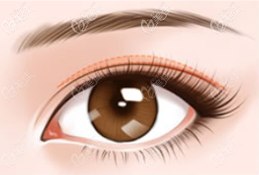 先減肥還是先做雙眼皮