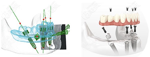 all-on-4種植牙技術(shù)優(yōu)勢
