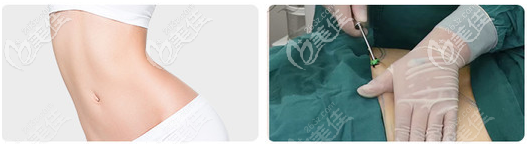 深圳藝星吸脂技術(shù)優(yōu)勢