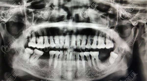 父親滿口牙松動(dòng)牙片