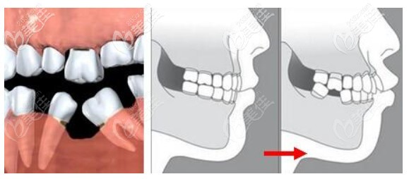關(guān)于牙齒缺失的危害 關(guān)于牙齒缺失的危害