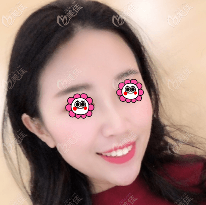 張春彥醫(yī)生做的光纖吸脂雙下巴效果還蠻好的,沒我擔(dān)心的有硬塊出現(xiàn)