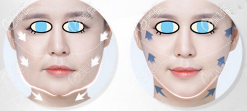 泰國(guó)拉皮手術(shù)的價(jià)格