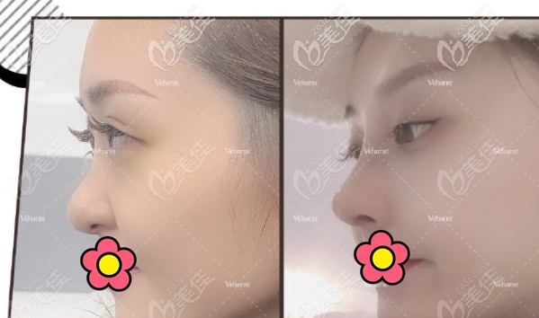 王旭明醫(yī)生半肋骨鼻綜合前后對(duì)比照片