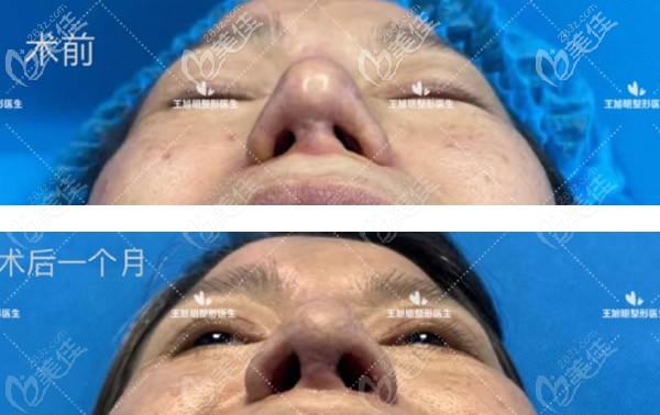 王旭明院長(zhǎng)鼻假體取出案例