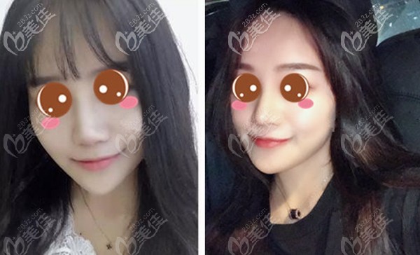 武漢楊斐半肋骨隆鼻半年效果對比