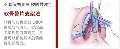半肋骨隆鼻鼻頭用自體軟骨支撐更穩(wěn)定