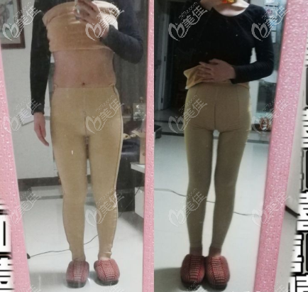 Suthipong Treeratana醫(yī)生大腿環(huán)吸<span style= Suthipong Treeratana醫(yī)生大腿環(huán)吸<span style=