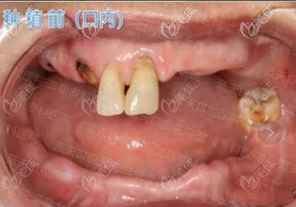 全口種植牙前 全口種植牙前
