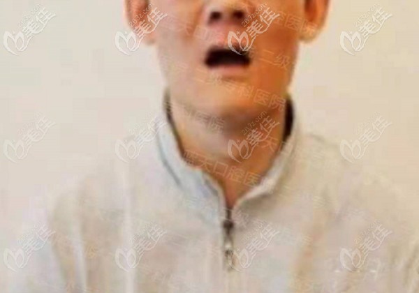 全口種植牙前的照片 全口種植牙前的照片