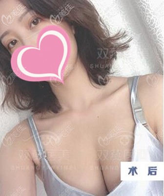 來看我在哈爾濱雙燕的隆胸體驗(yàn):手術(shù)不疼,做的曼托260cc假體還大成了C罩杯