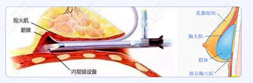 珠海九龍醫(yī)院內(nèi)窺鏡+雙平面隆胸技術(shù)