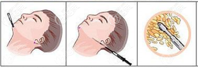 北京壹加壹面部吸脂損傷小，從隱蔽處進(jìn)針