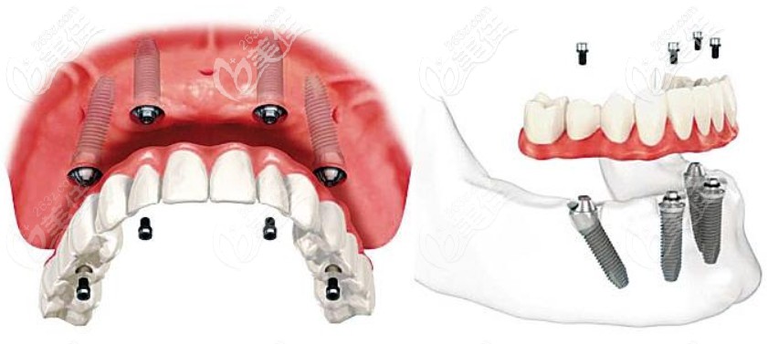 Allon4即刻種植牙技術(shù)