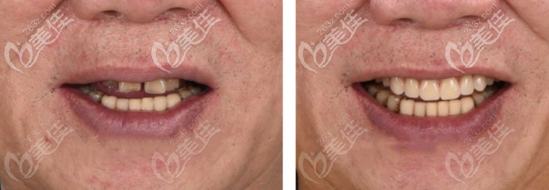 Allon6種植牙的前后對比圖