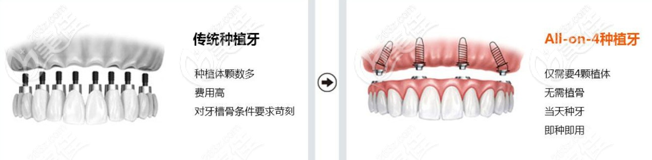 傳統(tǒng)種植牙的價格
