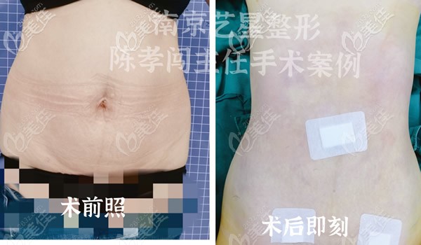 南京陳孝闖醫(yī)生吸脂技術(shù)怎么樣?他做的5g天使光雕腰腹環(huán)吸瘦肚子案例你瞅瞅