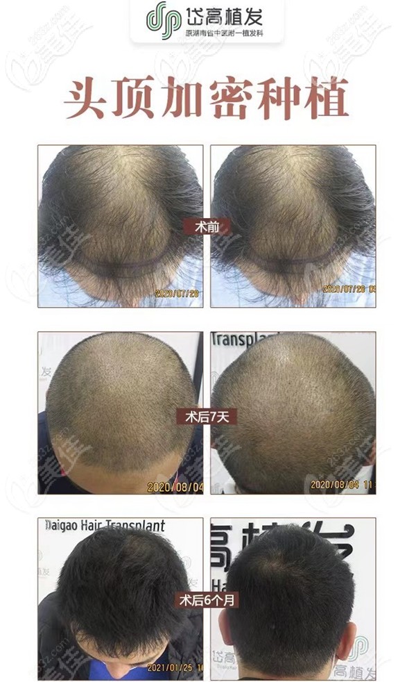岱高頭頂加密植發(fā)案例