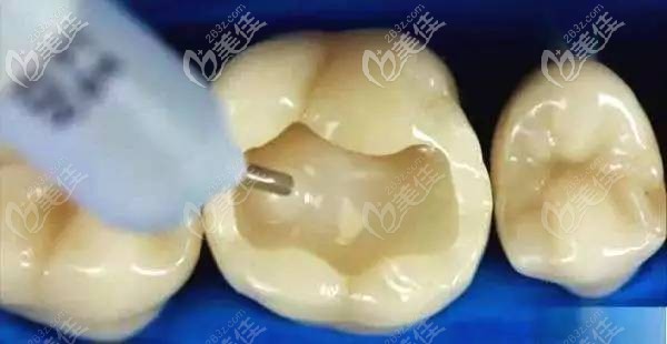 進(jìn)口3M樹脂材質(zhì)補(bǔ)牙