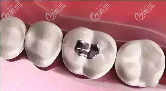 用銀汞合金材質(zhì)補(bǔ)牙示意圖